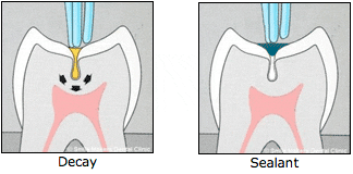photo-sealants-1.gif