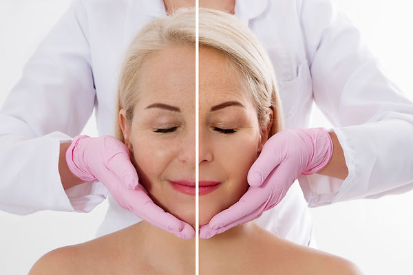 Biostimulators, Radiesse, Scupltra, collagen, elastin, neck lift, hand filler, dermal filler Burlington Ontario