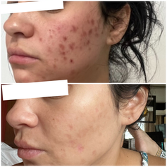 PicoSure Pro at Aloha Aesthetics MD