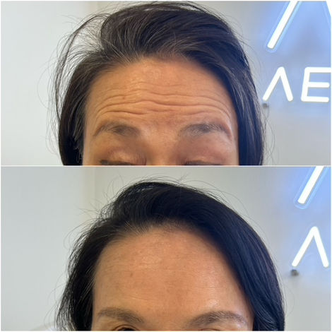 botox-before-after5