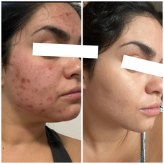 PicoSure Pro at Aloha Aesthetics MD