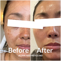 PicoSure Pro at Aloha Aesthetics MD