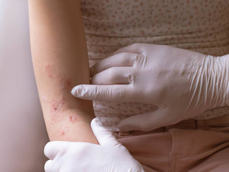 How Eczema Cream Helps Repair the Skin Barrier