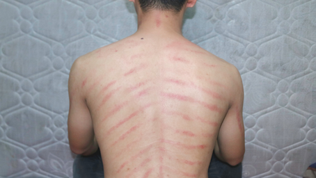 Learning Traditional Scraping Therapy: A Deep Dive into Indonesia's Ancient Art of Kerokan