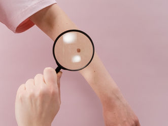 Gezondheidsraad: geen screening op huidkanker