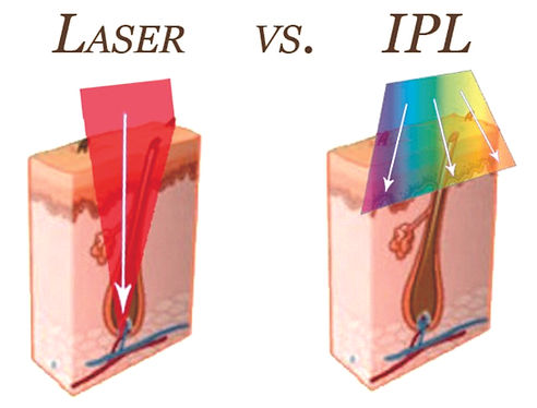 laser vs IPL.jpg