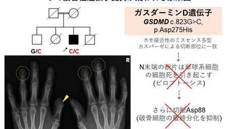 健康を科学で紐解く シリーズ116 「非定型的ゴーハム病における原因遺伝子変異の同定」