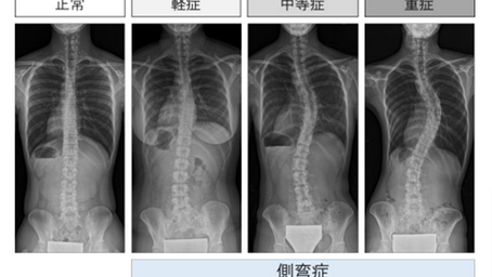 健康を科学で紐解く シリーズ95 「思春期特発性側弯症の発症の遺伝的な因果関係~