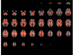 「統合失調症ではホモシステインが大脳白質の微細な構造異常に関連」-No.397
