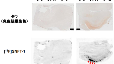 健康を科学で紐解く シリーズ119 「アルツハイマー病患者脳内のタウを高感度検出 早期発見」