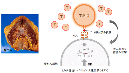 健康を科学で紐解く シリーズ180 「ヒト内在性レトロウイルス由来の腎がん抗原を発見」