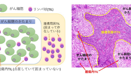 健康を科学で紐解く シリーズ125 「腫瘍内リンパ球と乳がん生存率との相関」