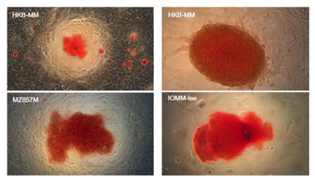 「世界初!腫瘍細胞増殖、老化(石灰化)のスイッチを発見」-No.373