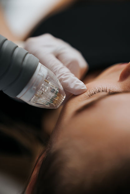 microneedling pic.jpg