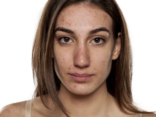 The truth about Acne.