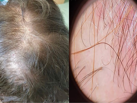 Telogen Effluvium Hair Loss Treatment Birmingham