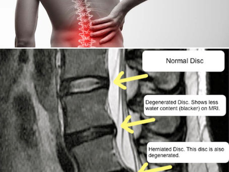 Chronic Back Pain Treatment Birmingham