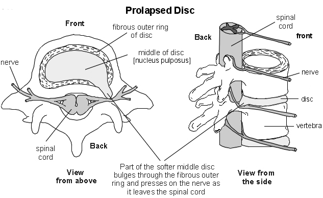 Disc Injury Treatment - Dynamic Osteopaths