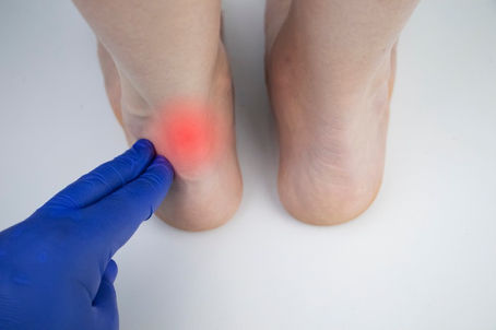 Achilles Tendinitis Treatment Birmingham and Warwickshire