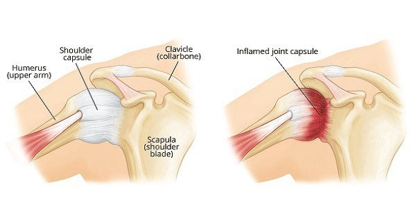 Comparison of PRP treatment and corticosteroid injection for frozen shoulder and peri-arthritis.
