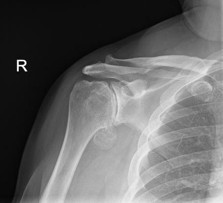 Treatment for Shoulder Arthritis Birmingham and Warwickshire