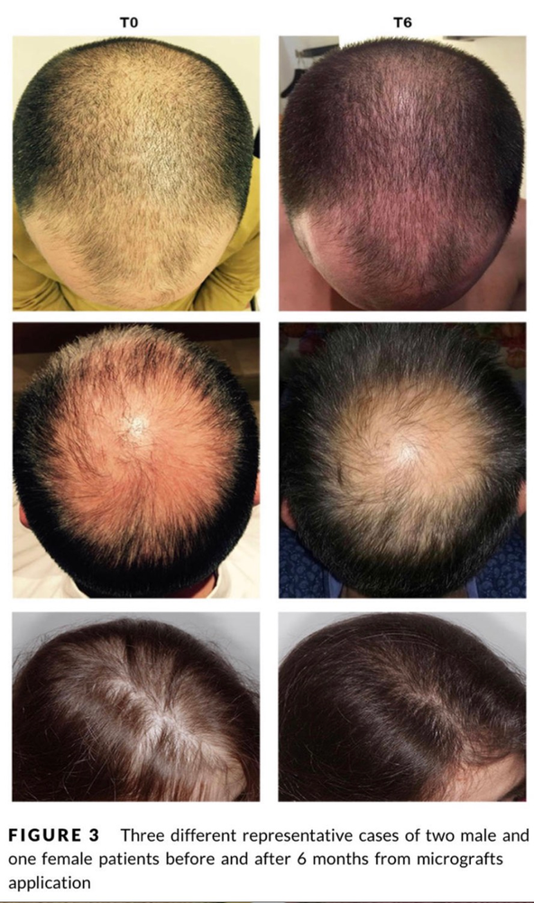 New Advances in Effective Hair Loss Treatment Progenitor‐cell