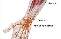 Wrist pain treatment Birmingham