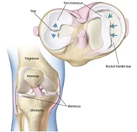 KNEE MENISCUS INJURY TREATMENT BIRMINGHAMUK
