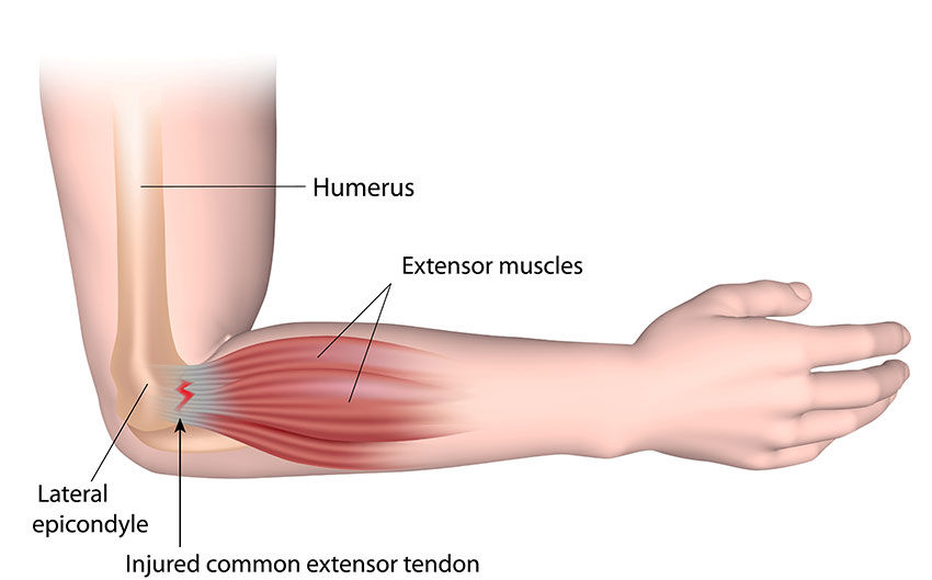 Tennis Elbow treatment. Dynamic Osteopaths Solihull