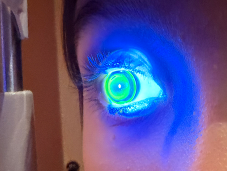 a pediatric patient being evaluated with orthokeratology lenses