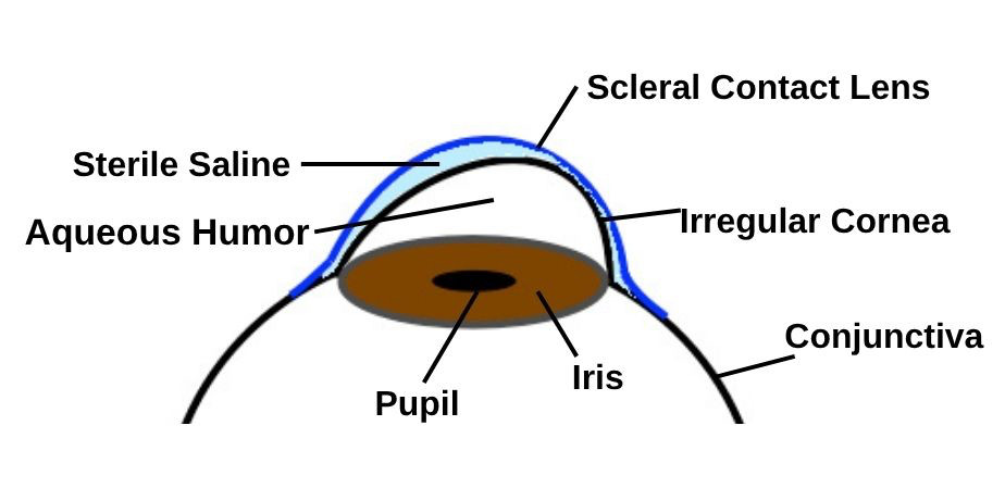 scleral contact lens image
