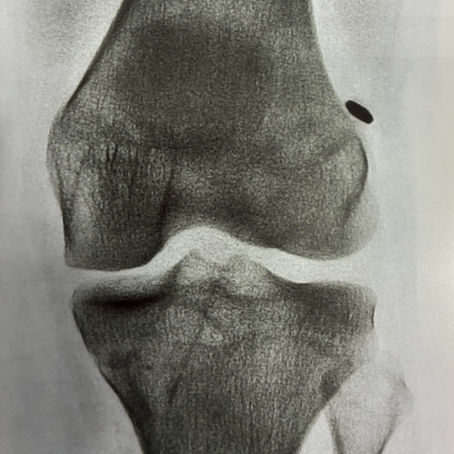 Especialista em Cirurgia de LCA: por que operar com um?