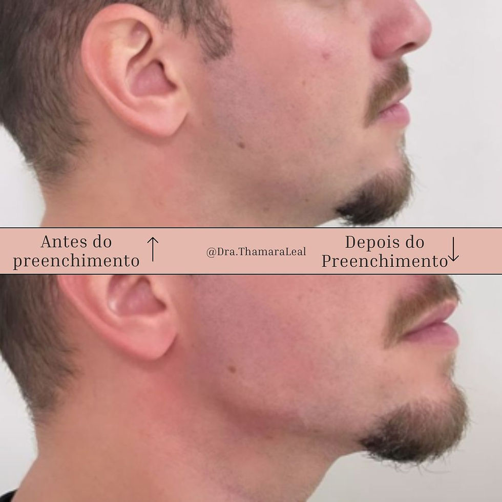 Preenchimento mandíbula