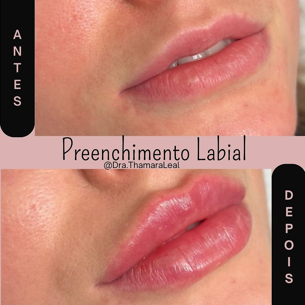 Preenchimento labial