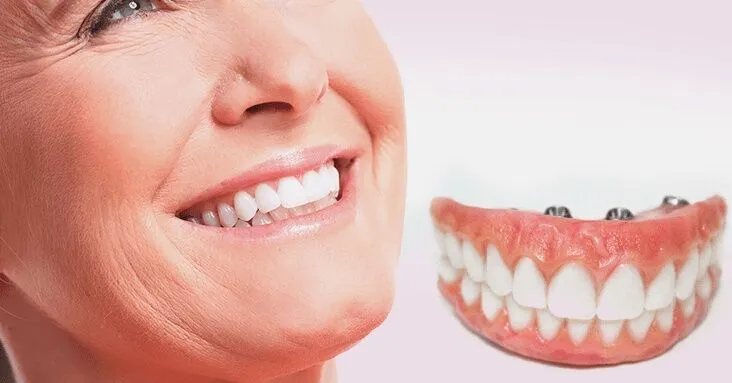 Ilustração de diversos tipos de prótese dentária