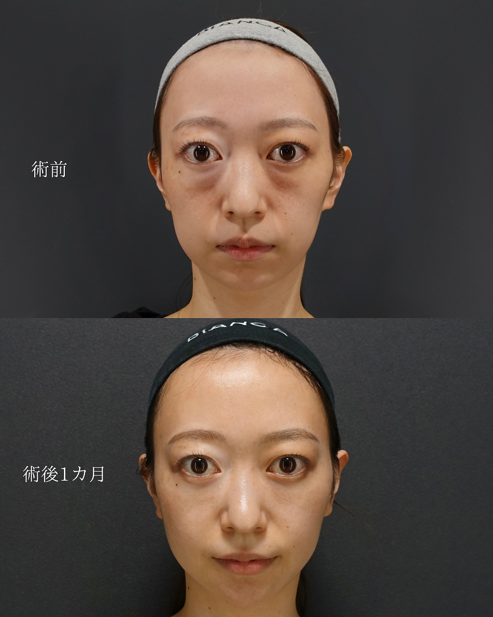 目の下のクマ治療(裏ハムラ法)