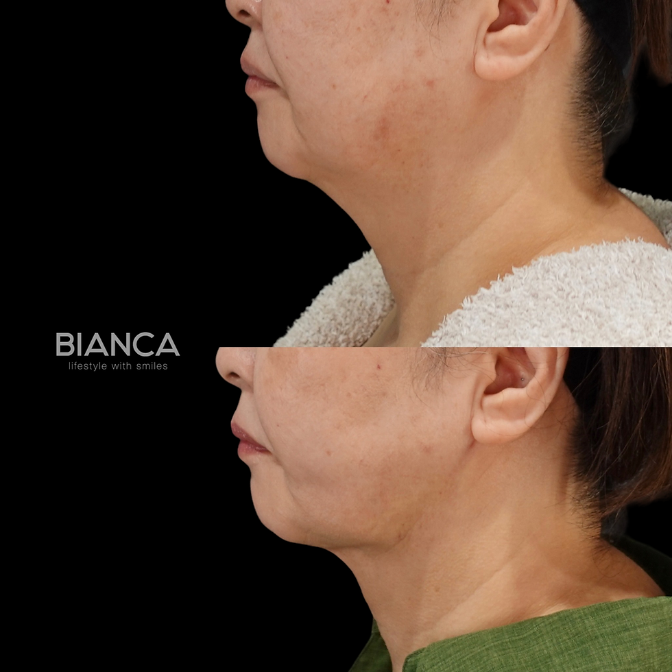 エンブレイス治療