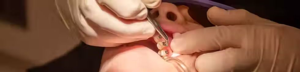 Braces at a glace