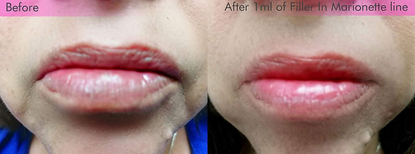 Fillers For Smile Lines Cheek And Jowl Salt Lake City Botox And Fillers