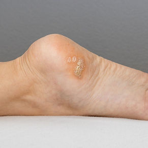 Comfort Steps Podiatry Wart Treatment
