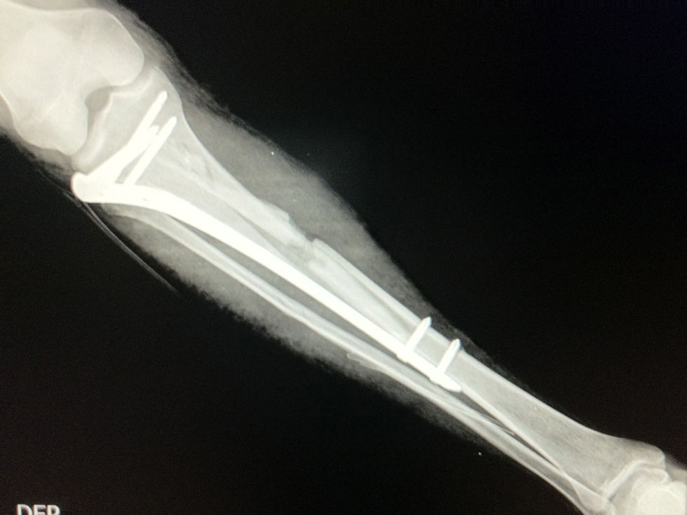 PO FRACTURA TIBIA DERECHA