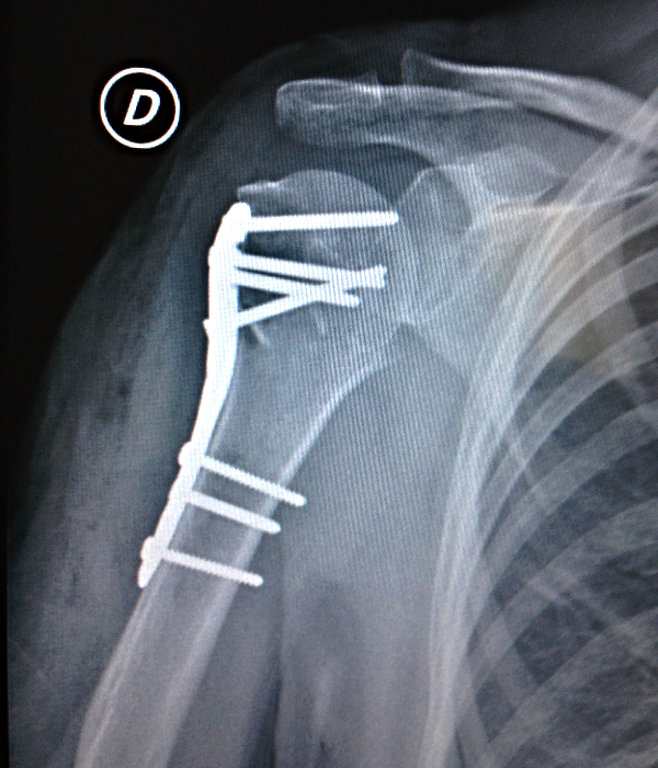 OSTEOSÍNTESIS HUMERO