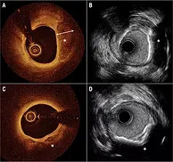 Percutaneous Coronary Intervention (PCI) with Intracoronary Imaging (OCT, IVUS)