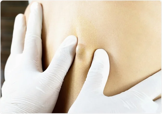 sebaceous cysts
