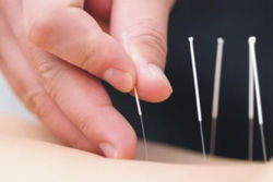 Acupuntura