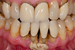 3 At Home Tips That Can Stop Gum Disease