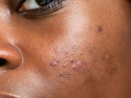 How to Avoid Having Dark Spots on Your Skin