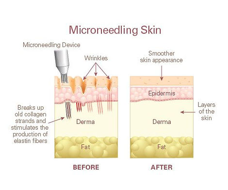 microneedling-diagram.jpg