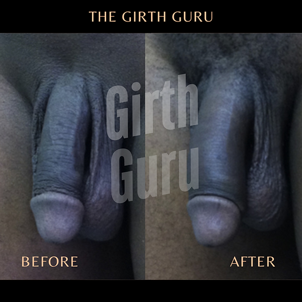 Before and after penis filler enhancement showing girth change, real client