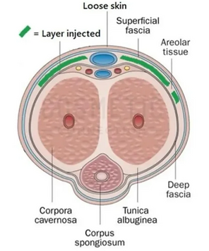 Cross-sectional diagram of the penis showing anatomical layers and the injection site for fillers.